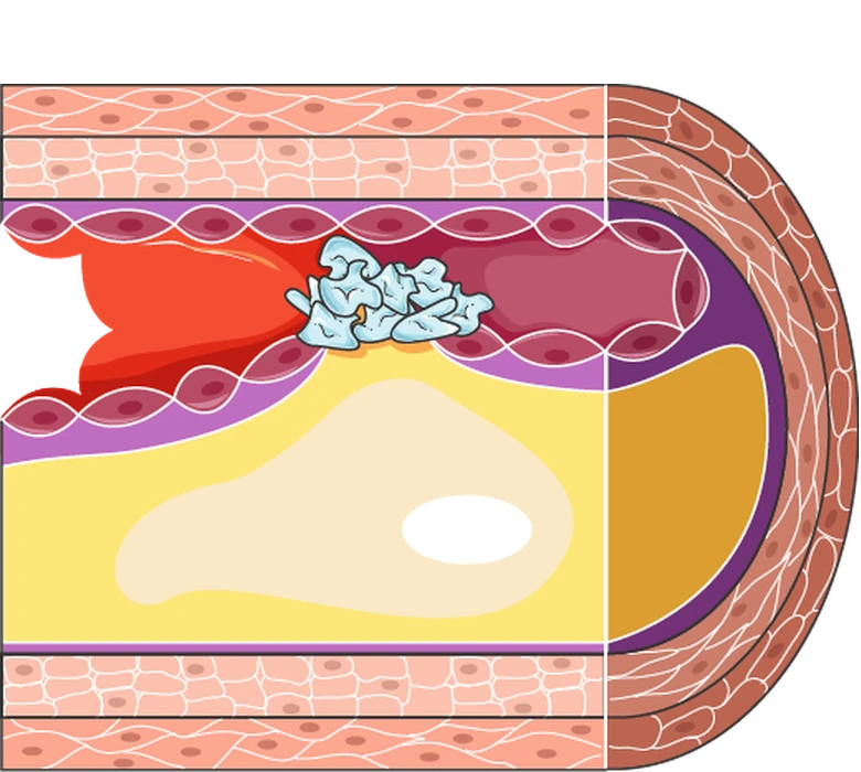 An artery cut lengthways: plaque has built up in the wall and ruptured, and a blood clot has formed on it.