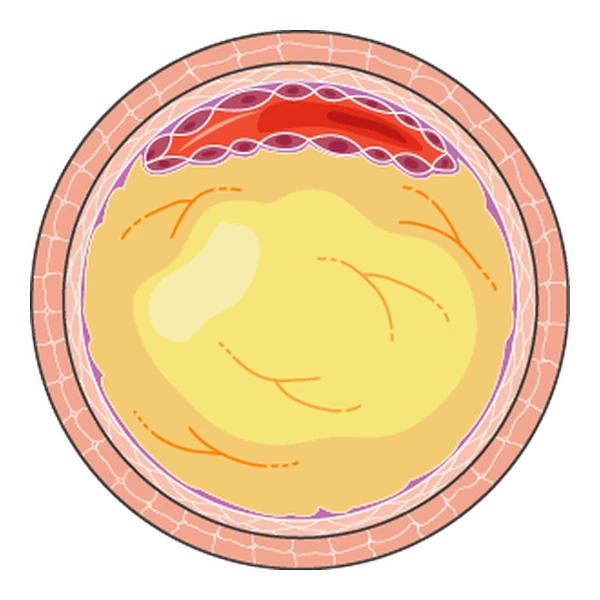 An artery cut across, almost blocked by fatty plaque in its wall.