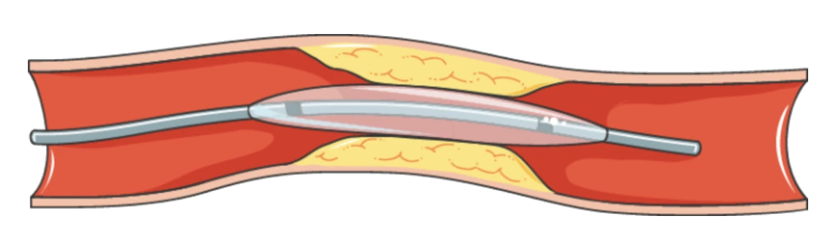 A narrowed artery with fatty plaque in its wall and a balloon on a catheter inside the narrowed section.